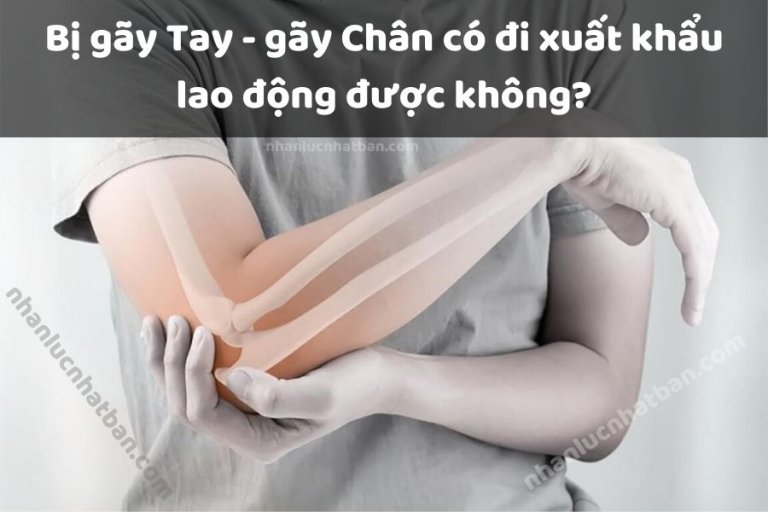 Trang Chủ 25 Bị gãy tay - gãy chân có đi xuất khẩu lao động được không-